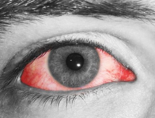 Las 10 causas del ojo rojo y cómo tratarlo